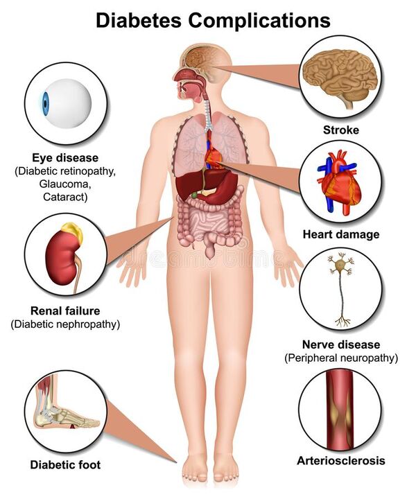 Consequences of diabetes